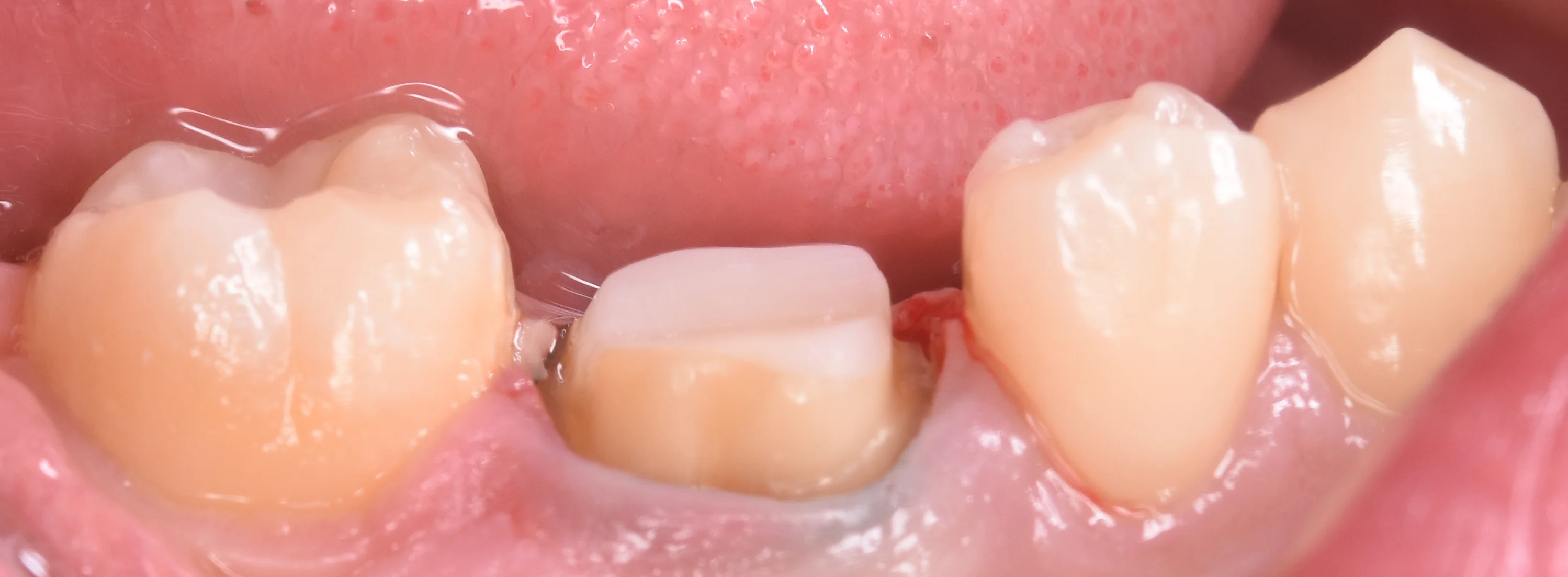 セラミックの被せ物｜坂寄歯科医院（取手市藤代） - 画像2