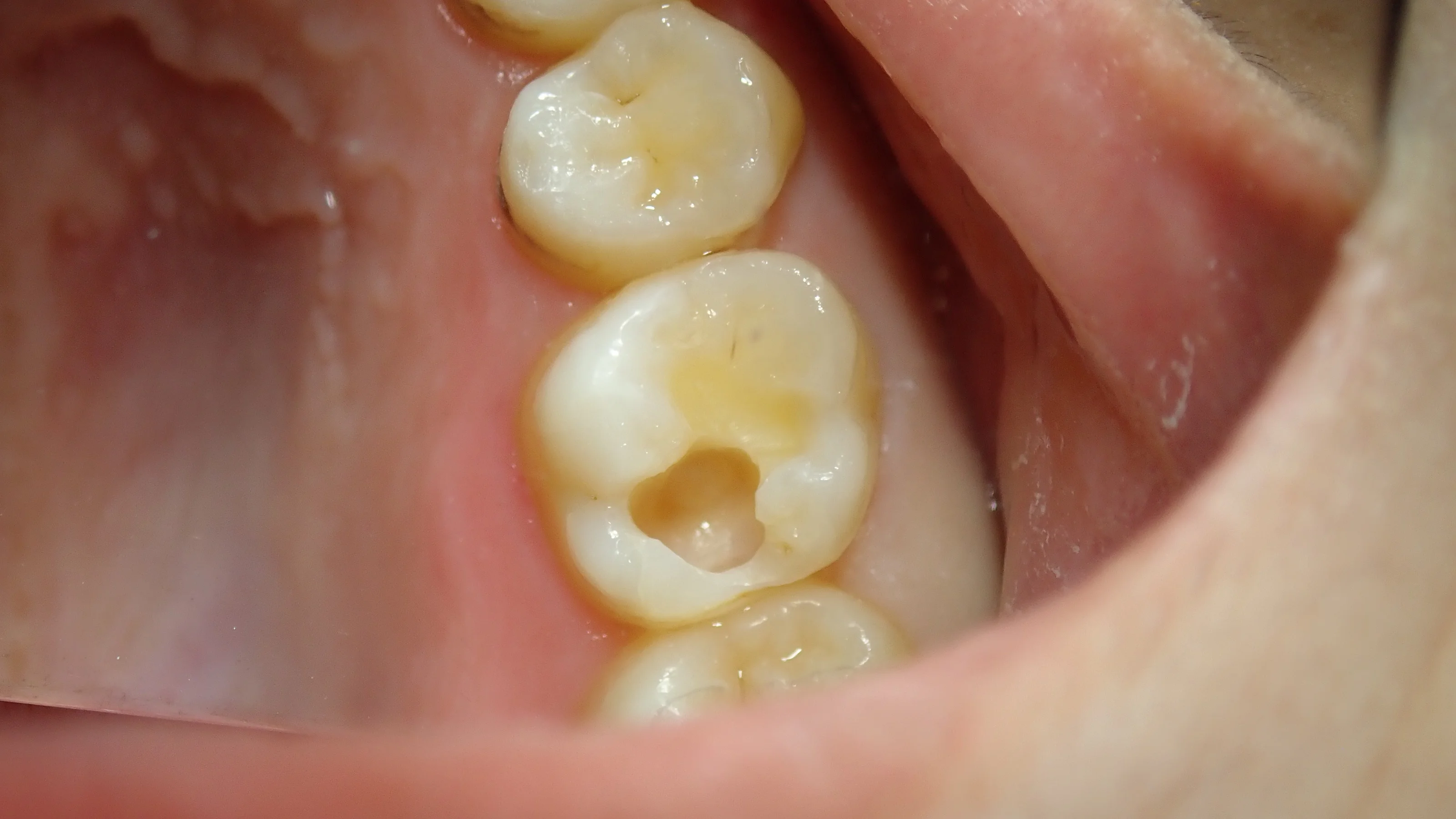 シールドレストレーション･･･？｜坂寄歯科医院（取手市藤代） - 画像4