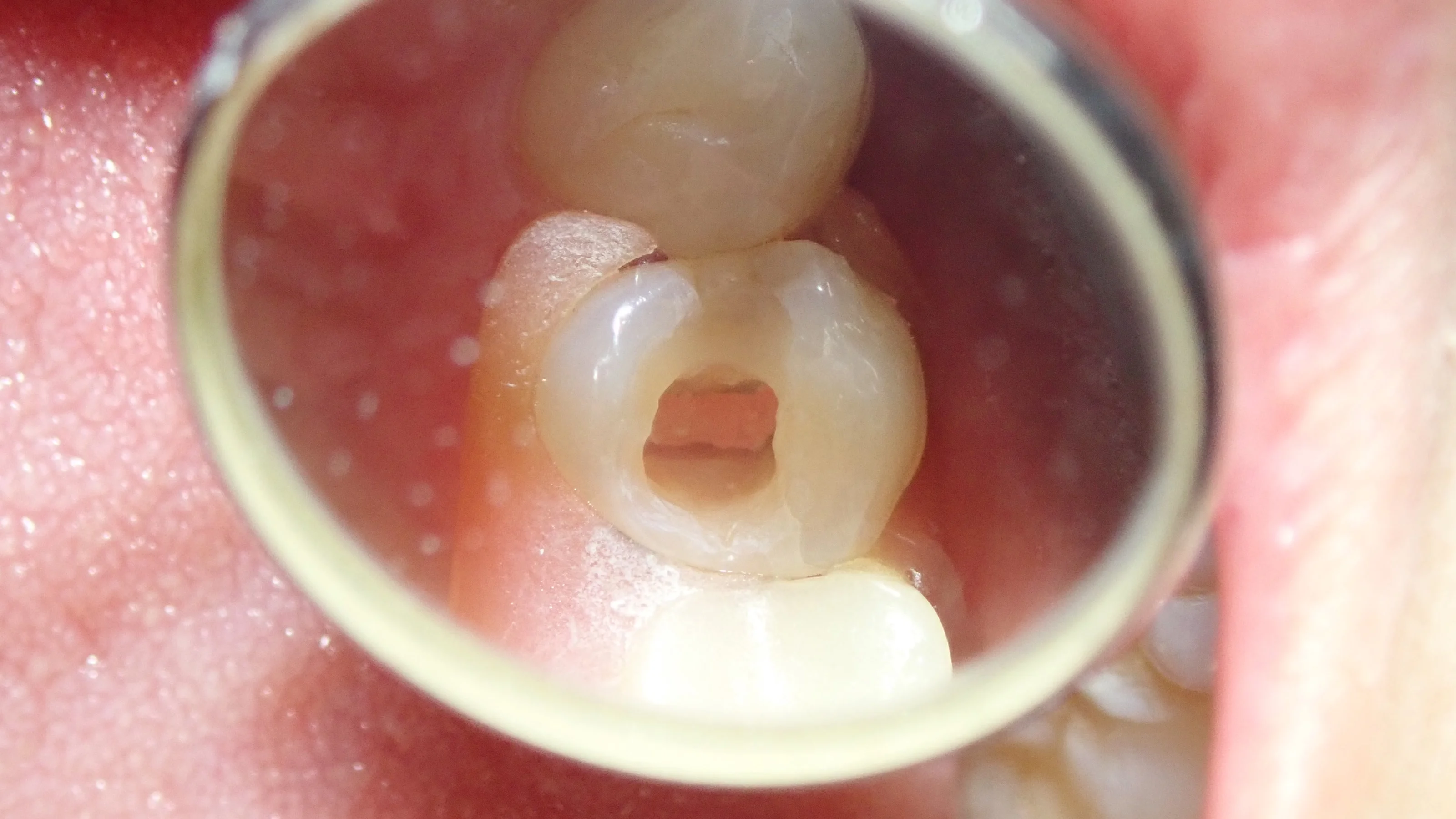 ダイレクトボンディング④｜坂寄歯科医院（取手市藤代） - 画像6