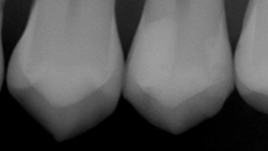 遠方より歯の治療を希望して｜坂寄歯科医院（取手市藤代） - 画像5
