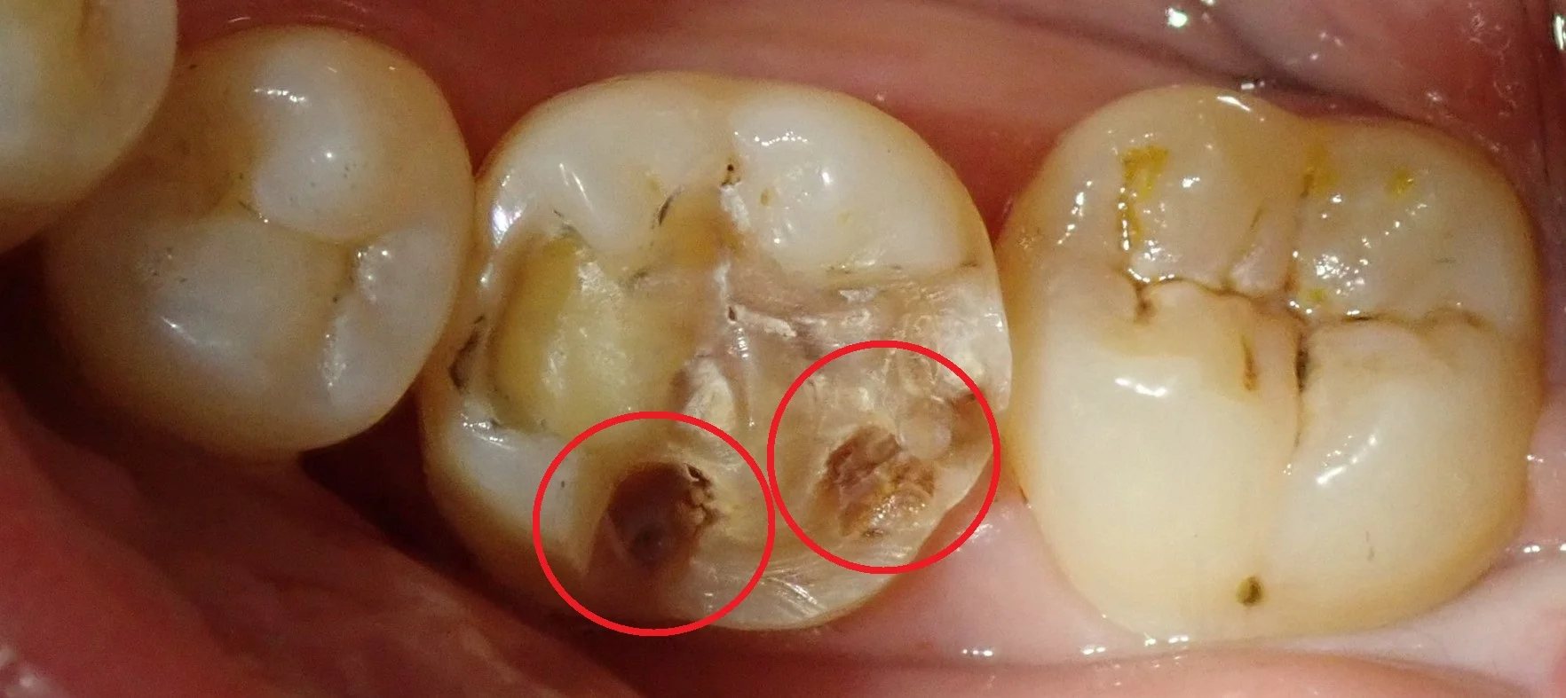 奥歯の白い詰め物|坂寄歯科医院(取手市藤代) - 画像2