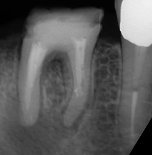 パーフォレーションリペア|坂寄歯科医院(取手市藤代) - 画像3