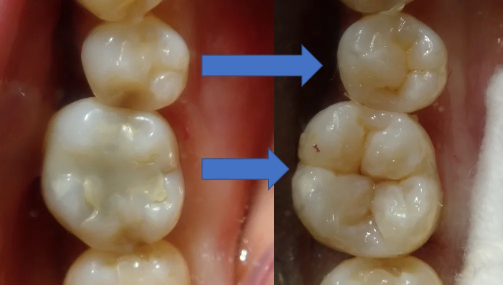 ダイレクトボンディング⑦｜坂寄歯科医院（取手市藤代） - 画像6