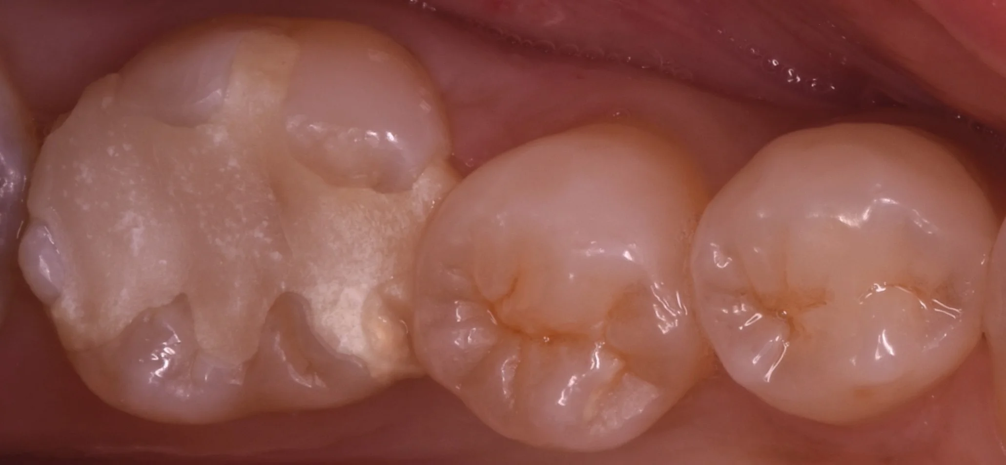 詰め物が脱離した所を即日で白い詰め物に。|坂寄歯科医院(取手市藤代) - 画像2