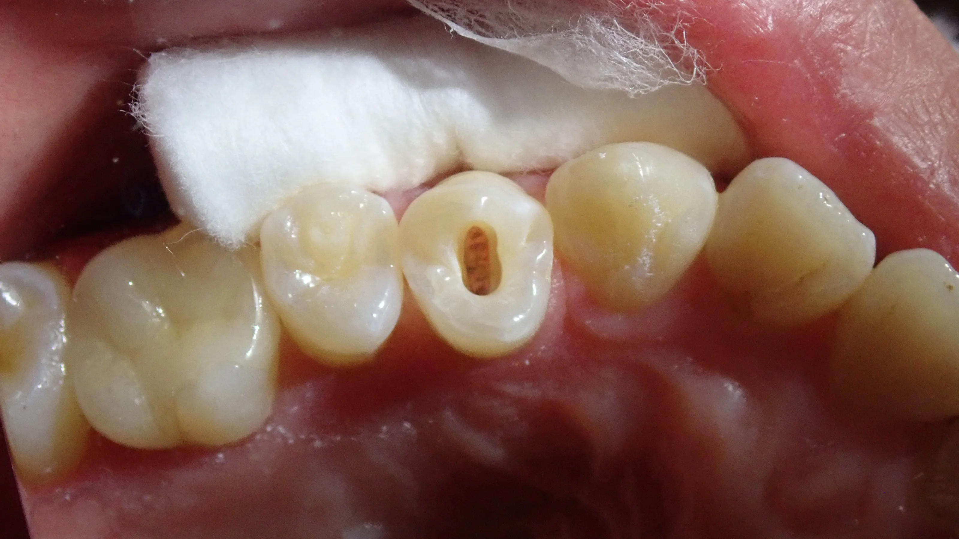 中心結節破折が原因で起こった神経の壊死を放置して、外部吸収が起こったケース|坂寄歯科医院(取手市藤代) - 画像3