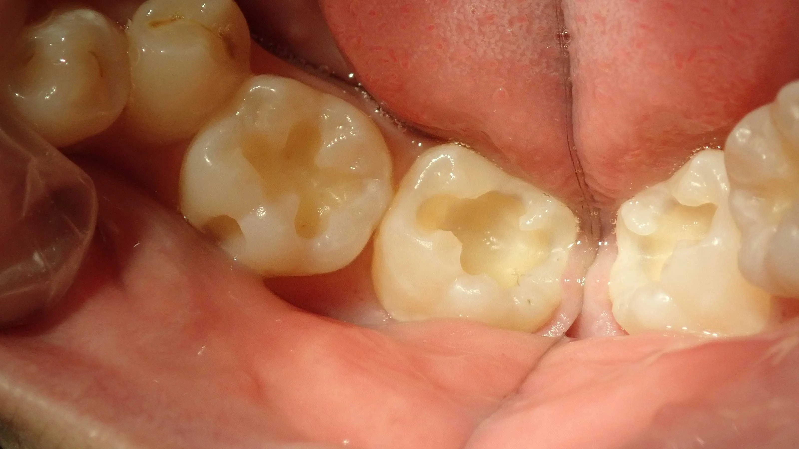 コンポジットレジン修復|坂寄歯科医院(取手市藤代) - 画像2