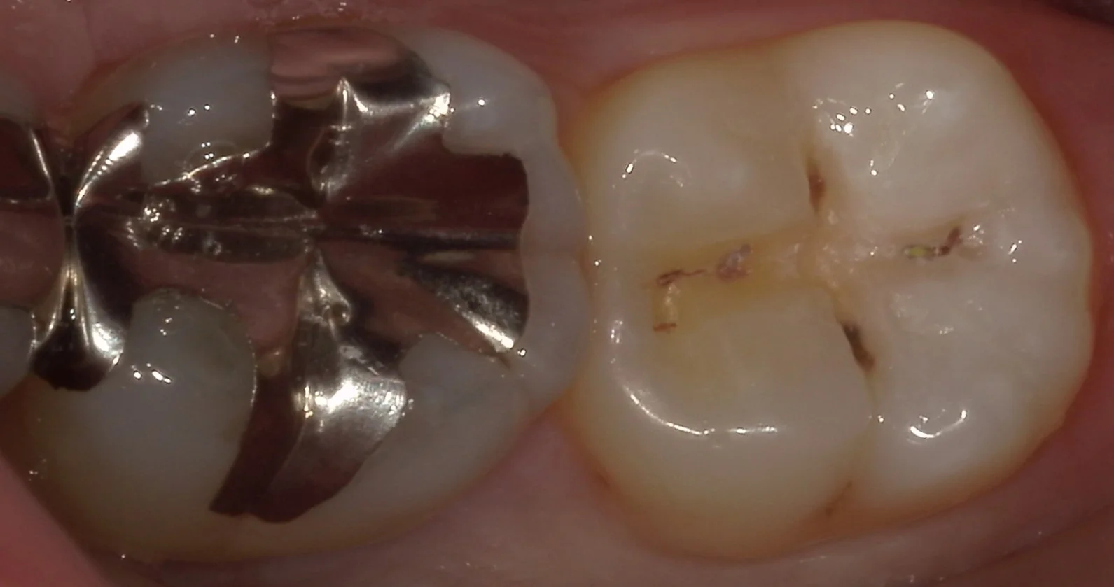 小さな虫歯ほど自費がおすすめ。｜坂寄歯科医院（取手市藤代） - 画像2