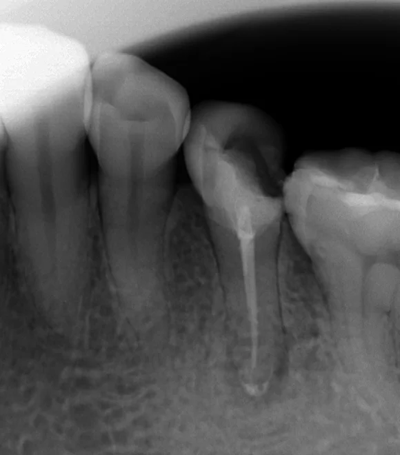 詰め物が欠けたまま放置した結果・・・|坂寄歯科医院(取手市藤代) - 画像2