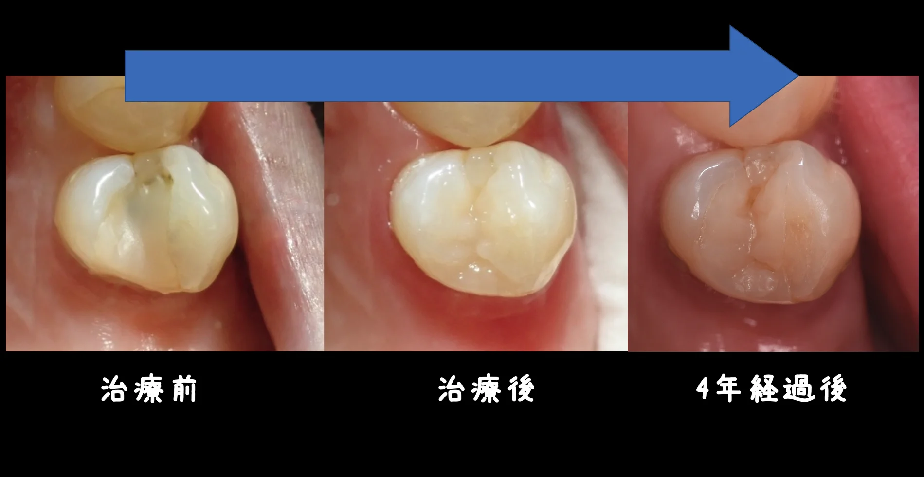 ダイレクトボンディング術後4年での補修修復｜坂寄歯科医院（取手市藤代） - 画像6