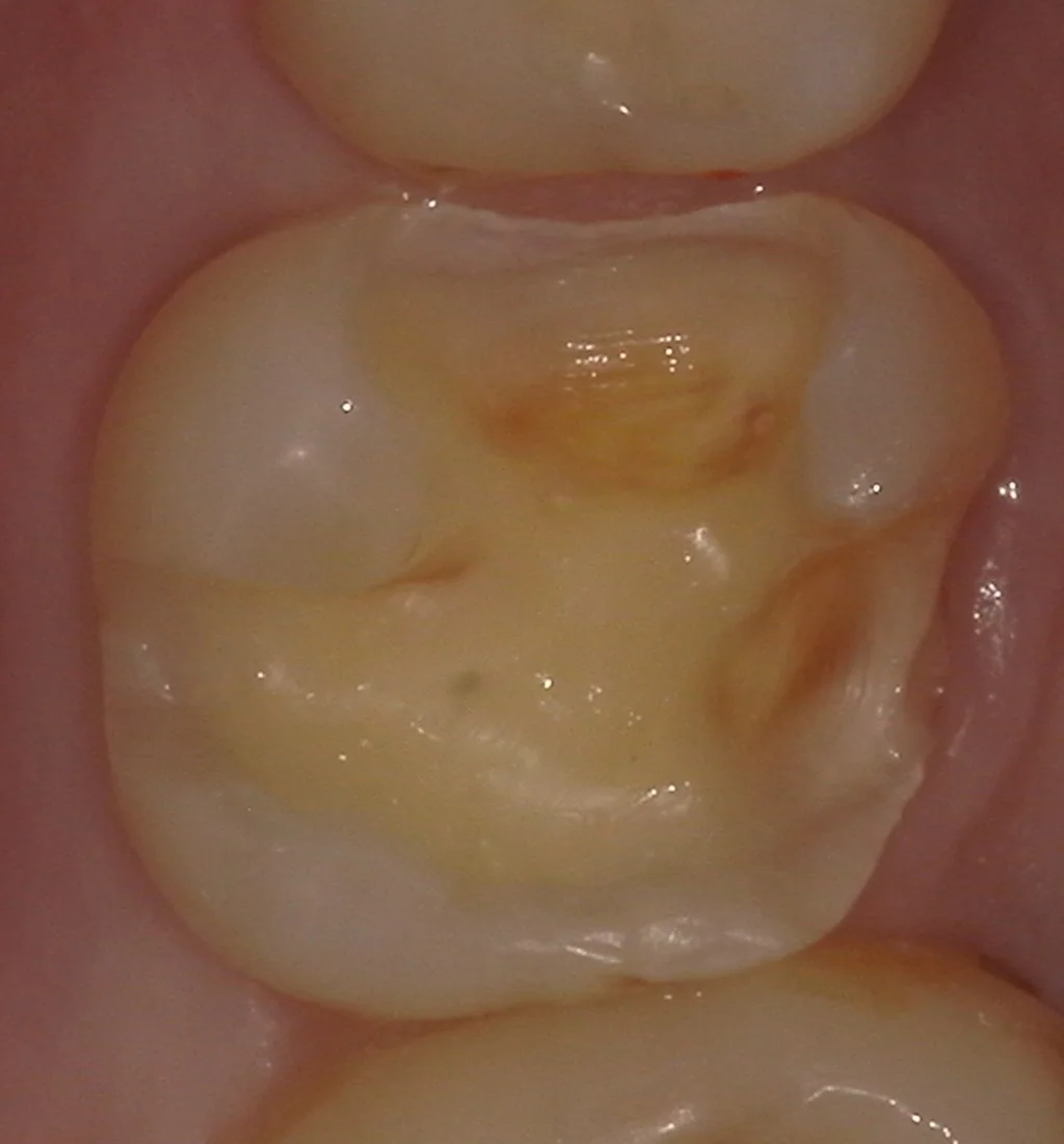 歯の側面も同時に治療したケース。|坂寄歯科医院(取手市藤代) - 画像3