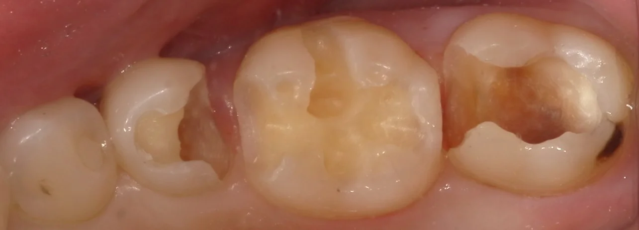 １回で纏めて一気に白い歯へ。｜坂寄歯科医院（取手市藤代） - 画像3