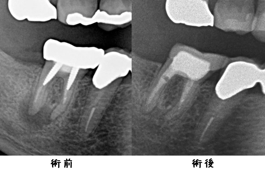 パーフォレーションリペア|坂寄歯科医院(取手市藤代) - 画像4