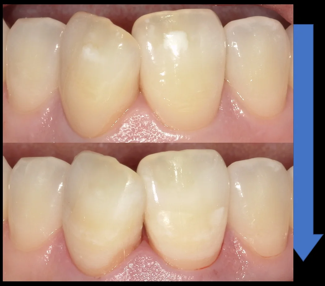 ICON治療(低侵襲ホワイトスポット改善治療)を始めました。｜坂寄歯科医院（取手市藤代） - 画像6