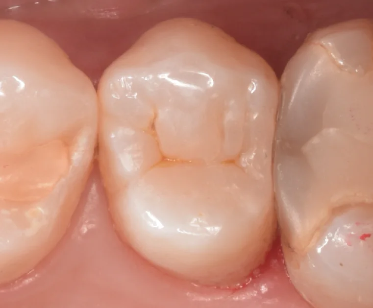 開業歯科医師の方を治療。|坂寄歯科医院(取手市藤代) - 画像4