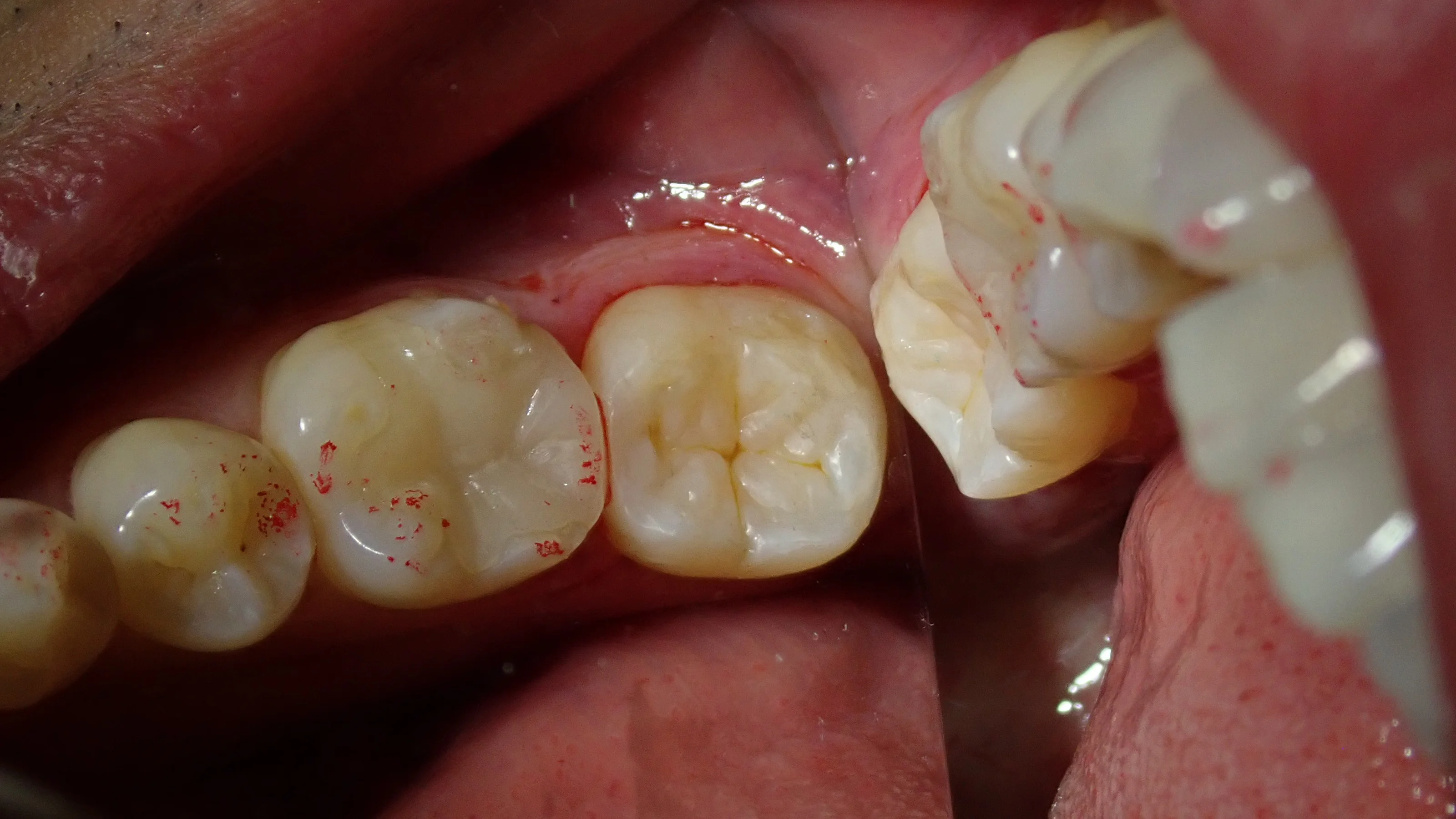 左下奥の白い詰め物|坂寄歯科医院(取手市藤代) - 画像3