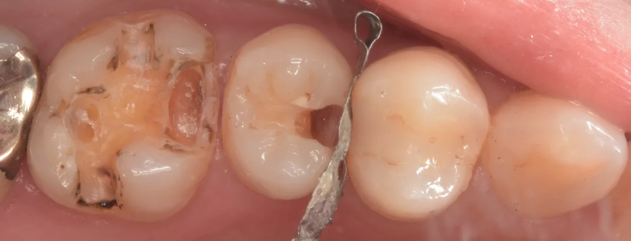 歯科医師の方を治療。|坂寄歯科医院(取手市藤代) - 画像2