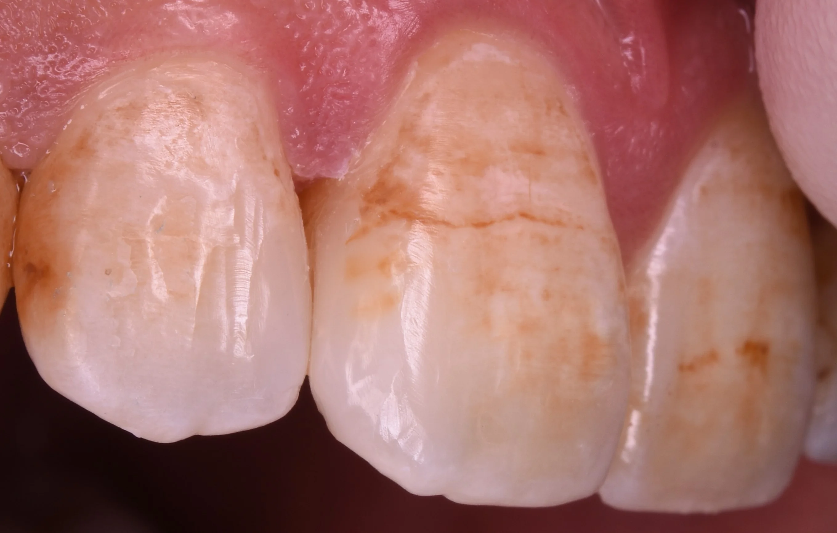 前歯の虫歯の治療で可能な限り歯を温存したケース。｜坂寄歯科医院（取手市藤代） - 画像4