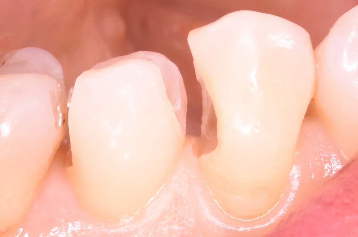 奥歯の歯並びが悪くなってしまっている所の治療|坂寄歯科医院(取手市藤代) - 画像4