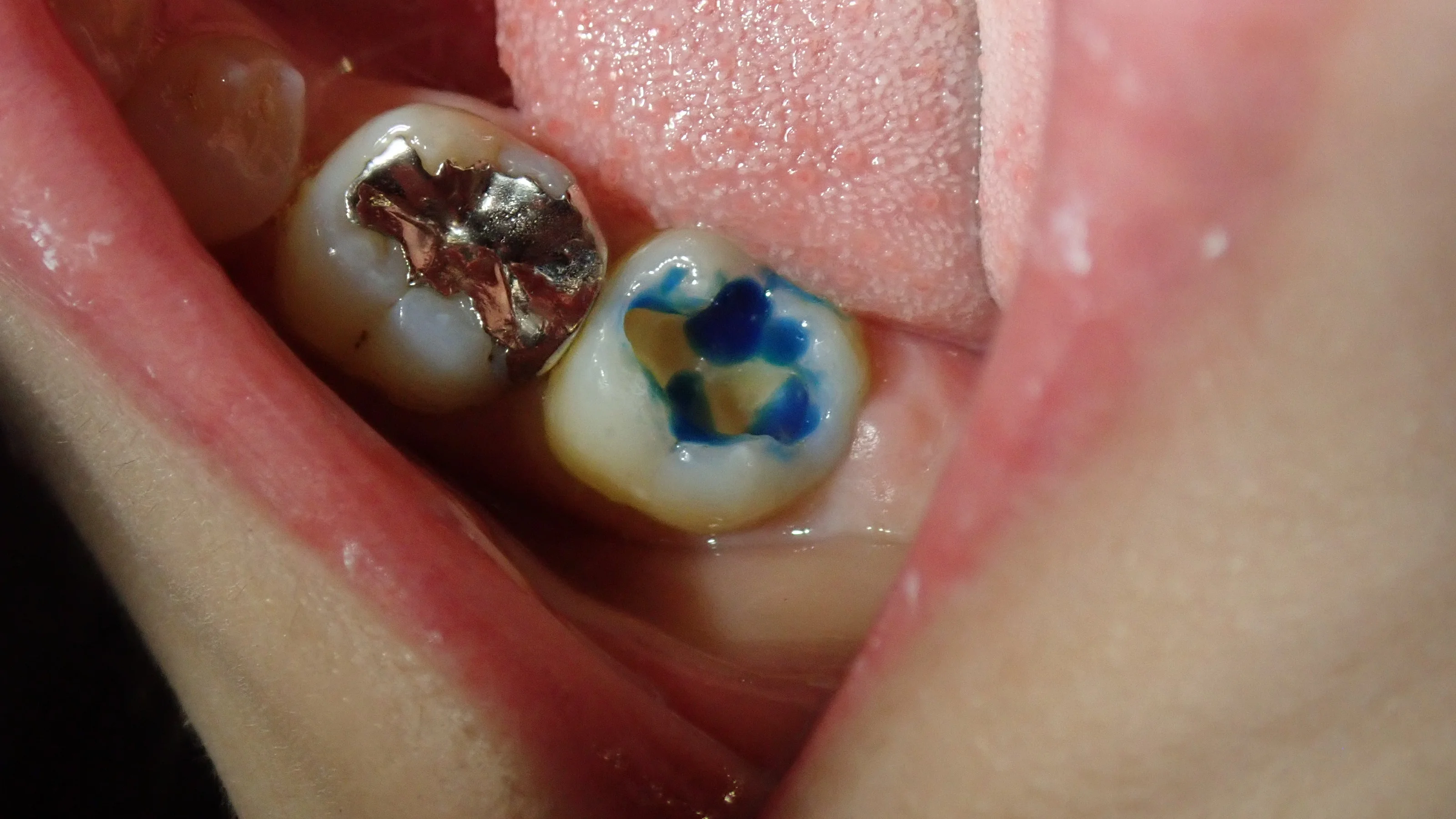 奥２本のダイレクトボンディング｜坂寄歯科医院（取手市藤代） - 画像2