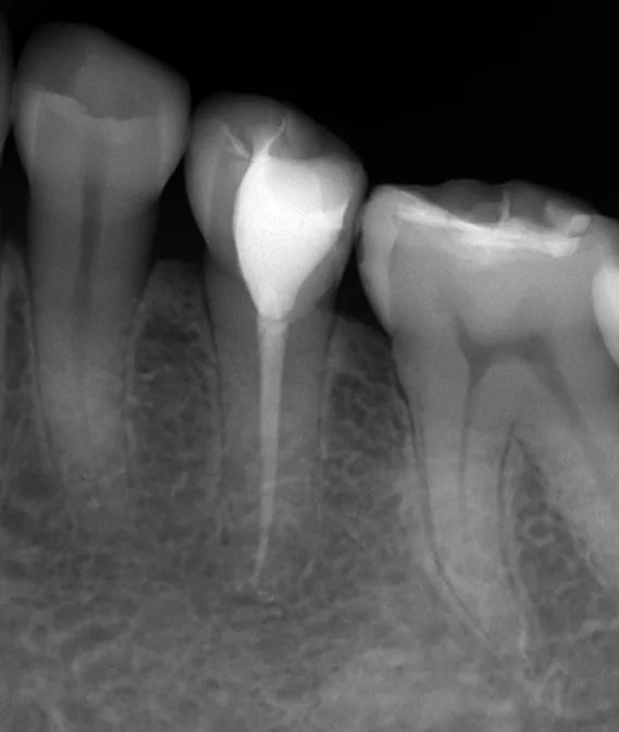 詰め物が欠けたまま放置した結果・・・|坂寄歯科医院(取手市藤代) - 画像3