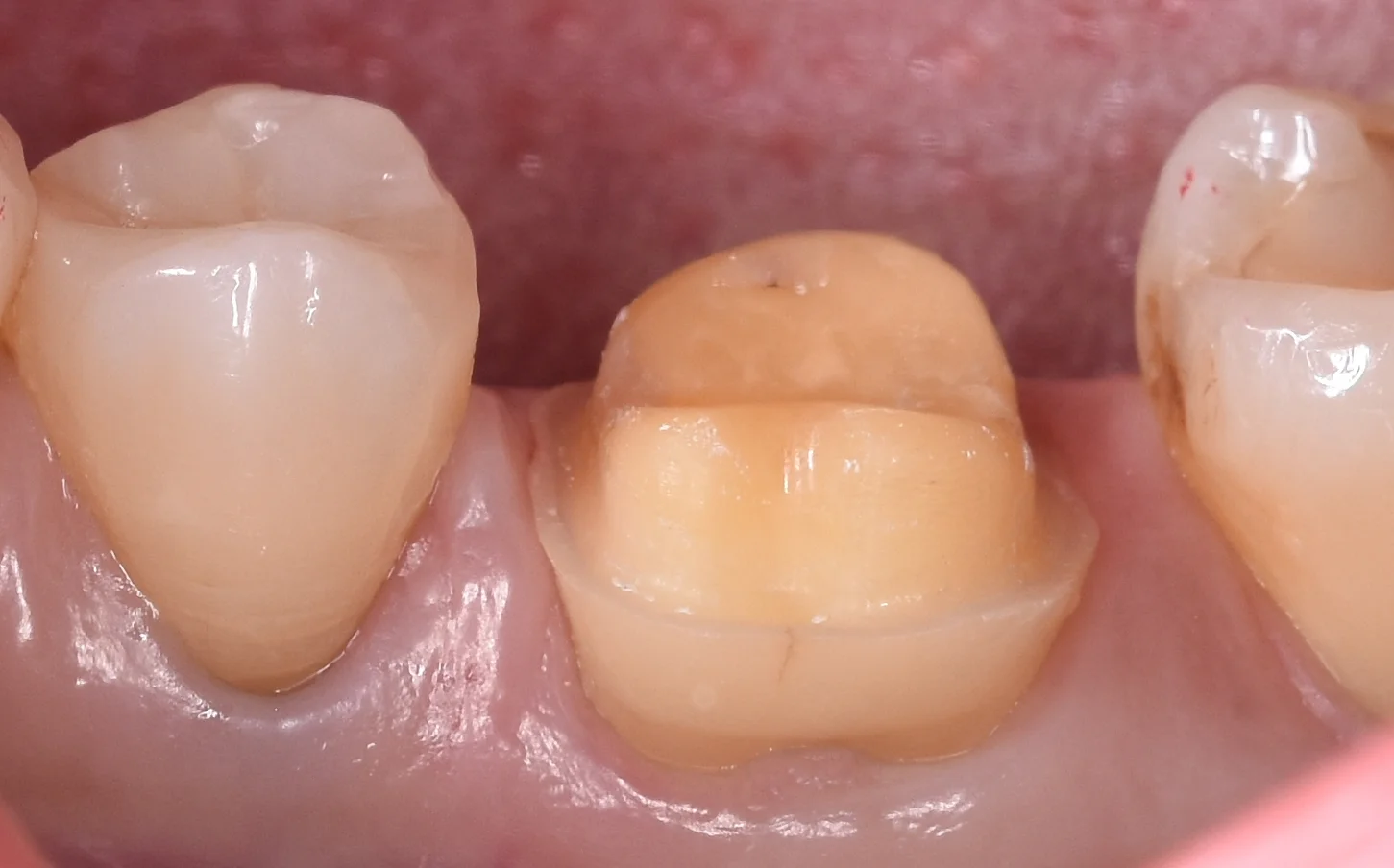 歯の亀裂で痛みが出たため、被せ物に。|坂寄歯科医院(取手市藤代) - 画像2