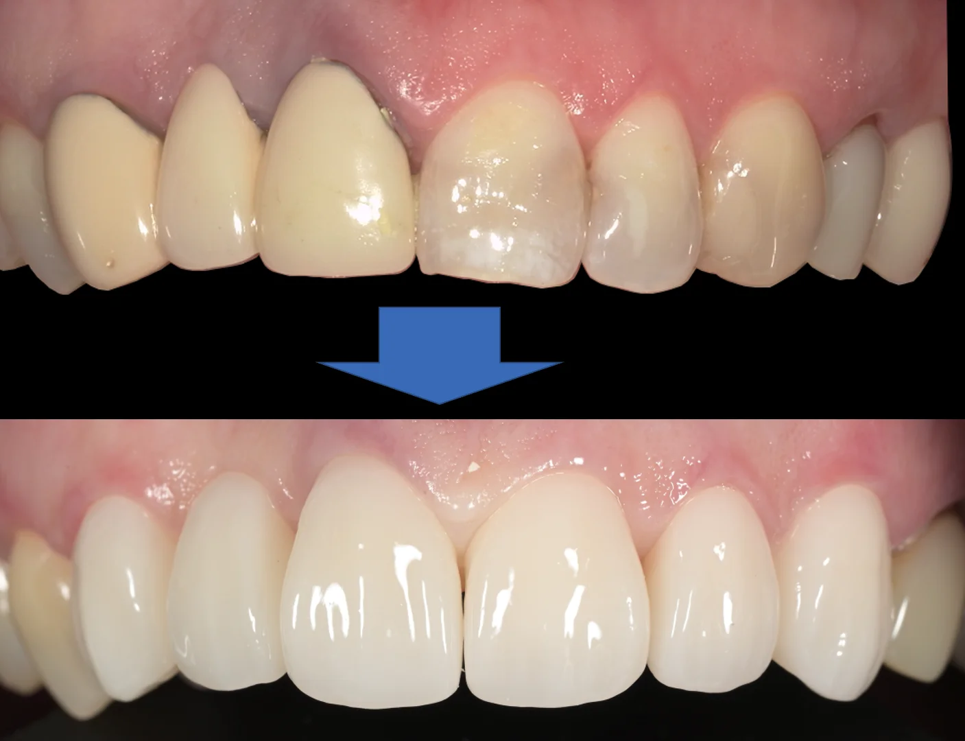 審美治療:セラミック|坂寄歯科医院(取手市藤代) - 画像6