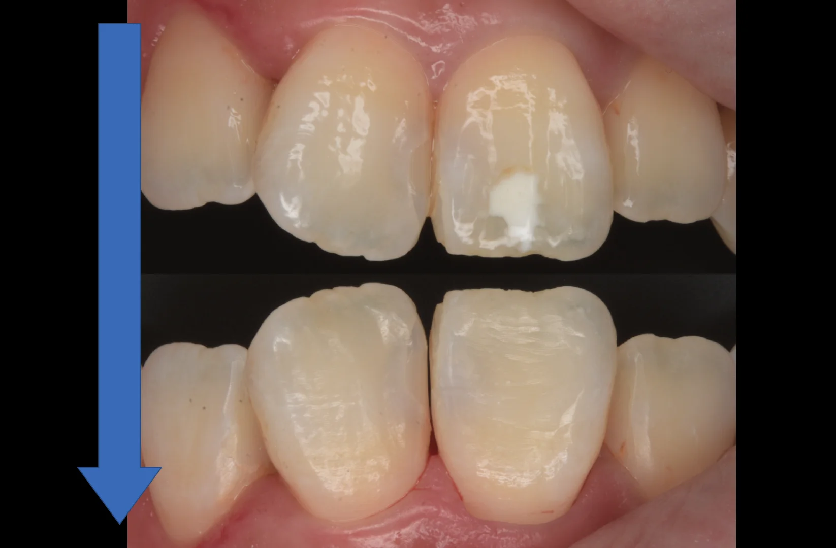 ICON治療にて改善しきらなかったケース。|坂寄歯科医院(取手市藤代) - 画像4