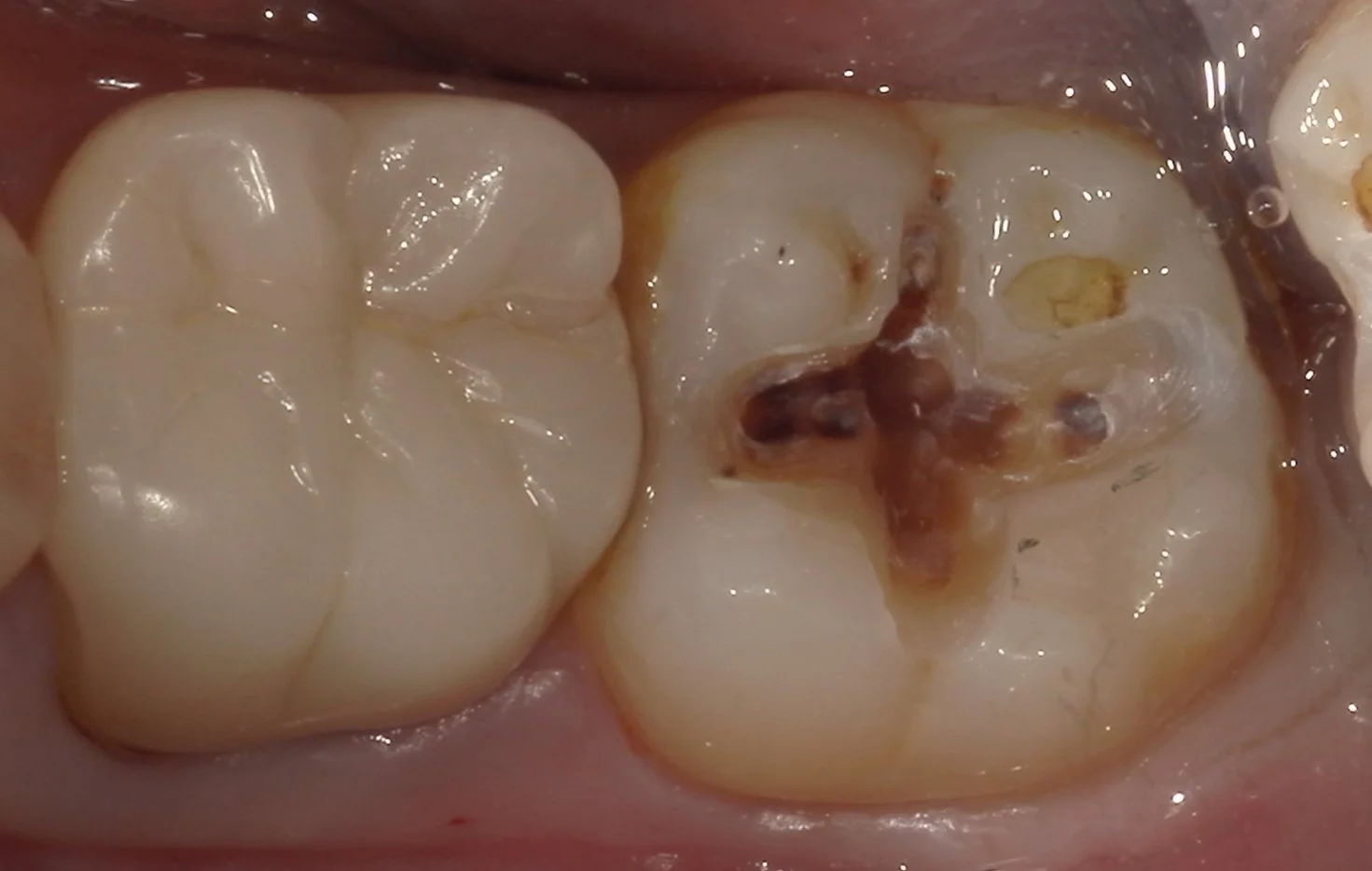 遠方より虫歯の治療で通院された方を一日で治療しました。|坂寄歯科医院(取手市藤代) - 画像2
