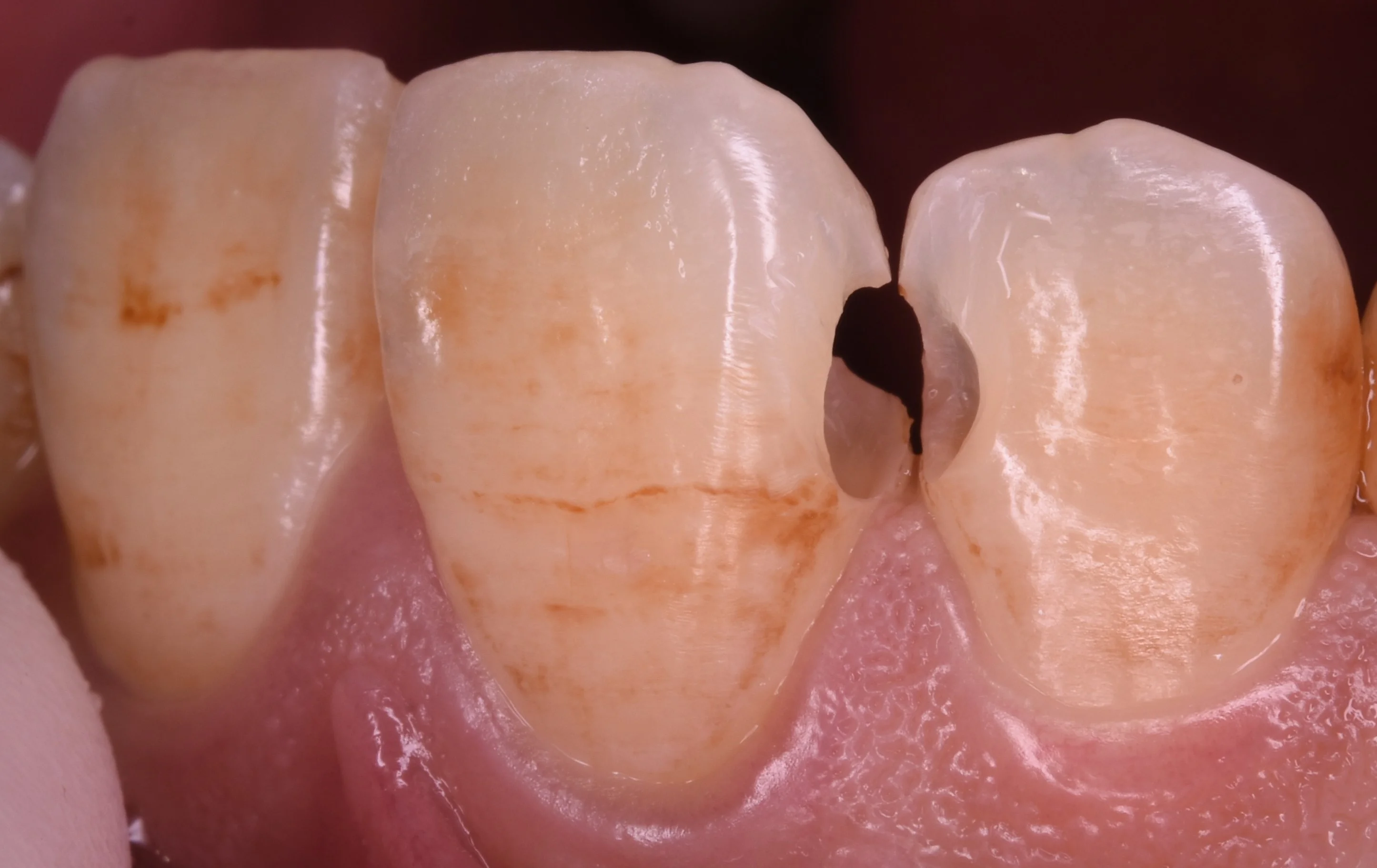 前歯の虫歯の治療で可能な限り歯を温存したケース。｜坂寄歯科医院（取手市藤代） - 画像3