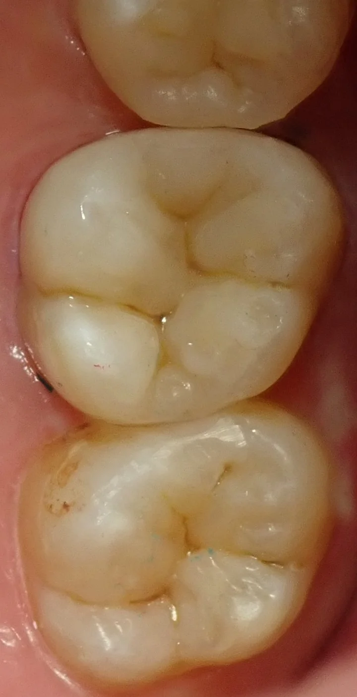 左上奥歯の白い詰め物｜坂寄歯科医院（取手市藤代） - 画像4
