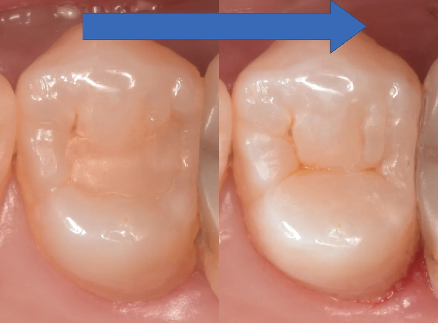 開業歯科医師の方を治療。|坂寄歯科医院(取手市藤代) - 画像6