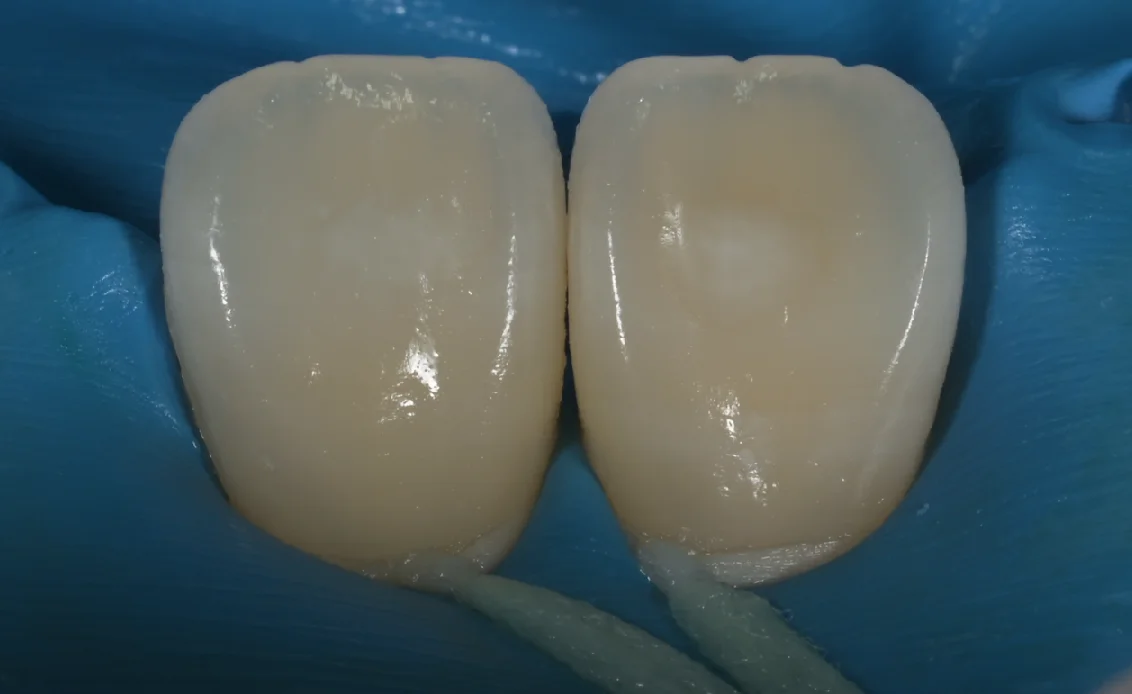 ICON治療。｜坂寄歯科医院（取手市藤代） - 画像5