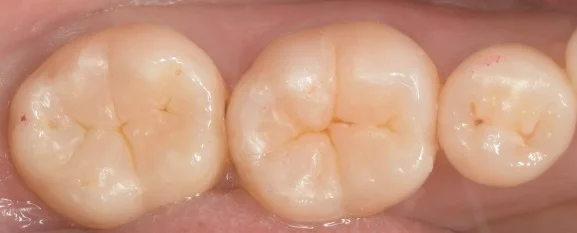 見た目が気になるレジンを天然の歯の様に。｜坂寄歯科医院（取手市藤代） - 画像3