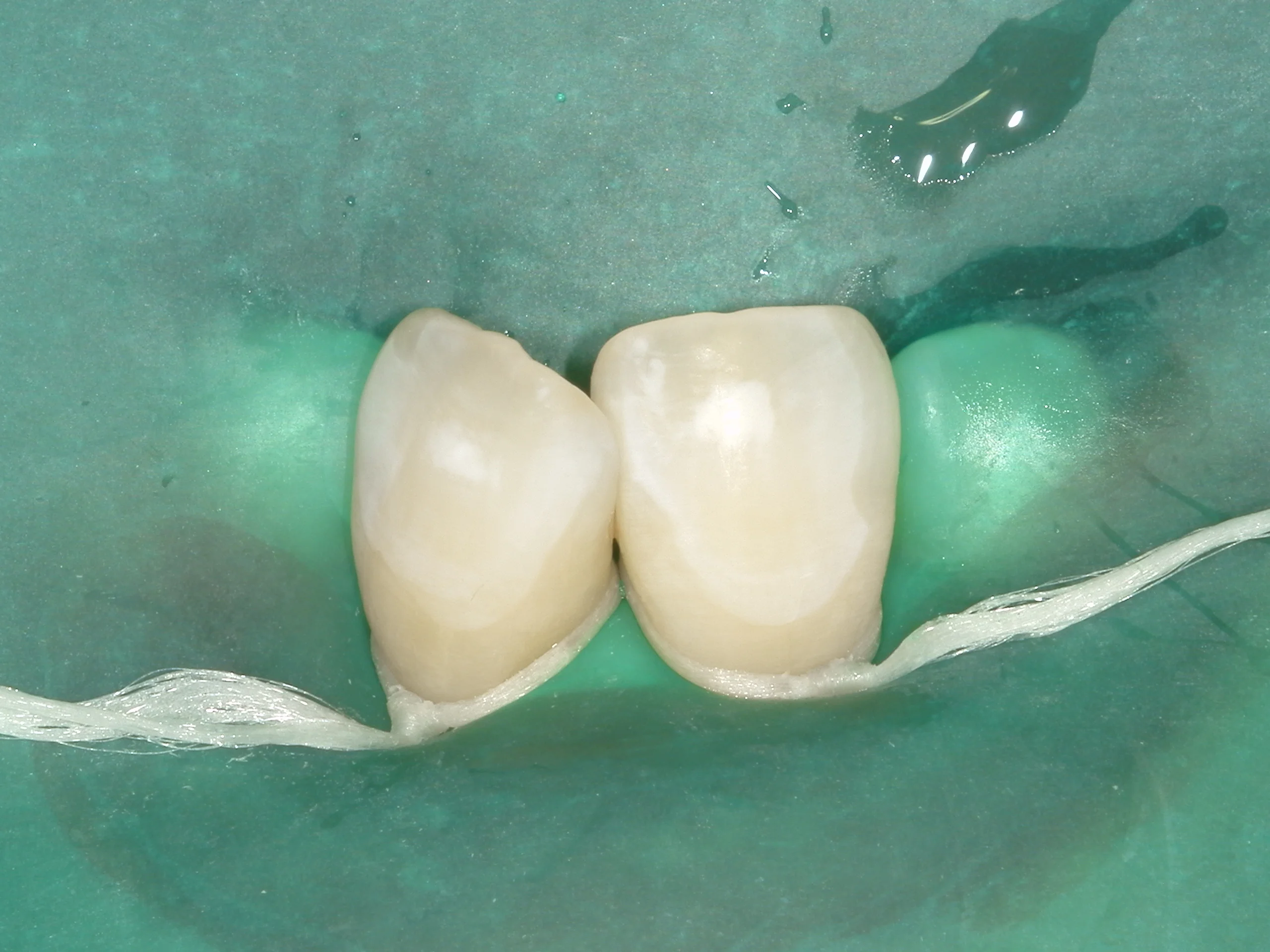 ICON治療(低侵襲ホワイトスポット改善治療)を始めました。｜坂寄歯科医院（取手市藤代） - 画像4