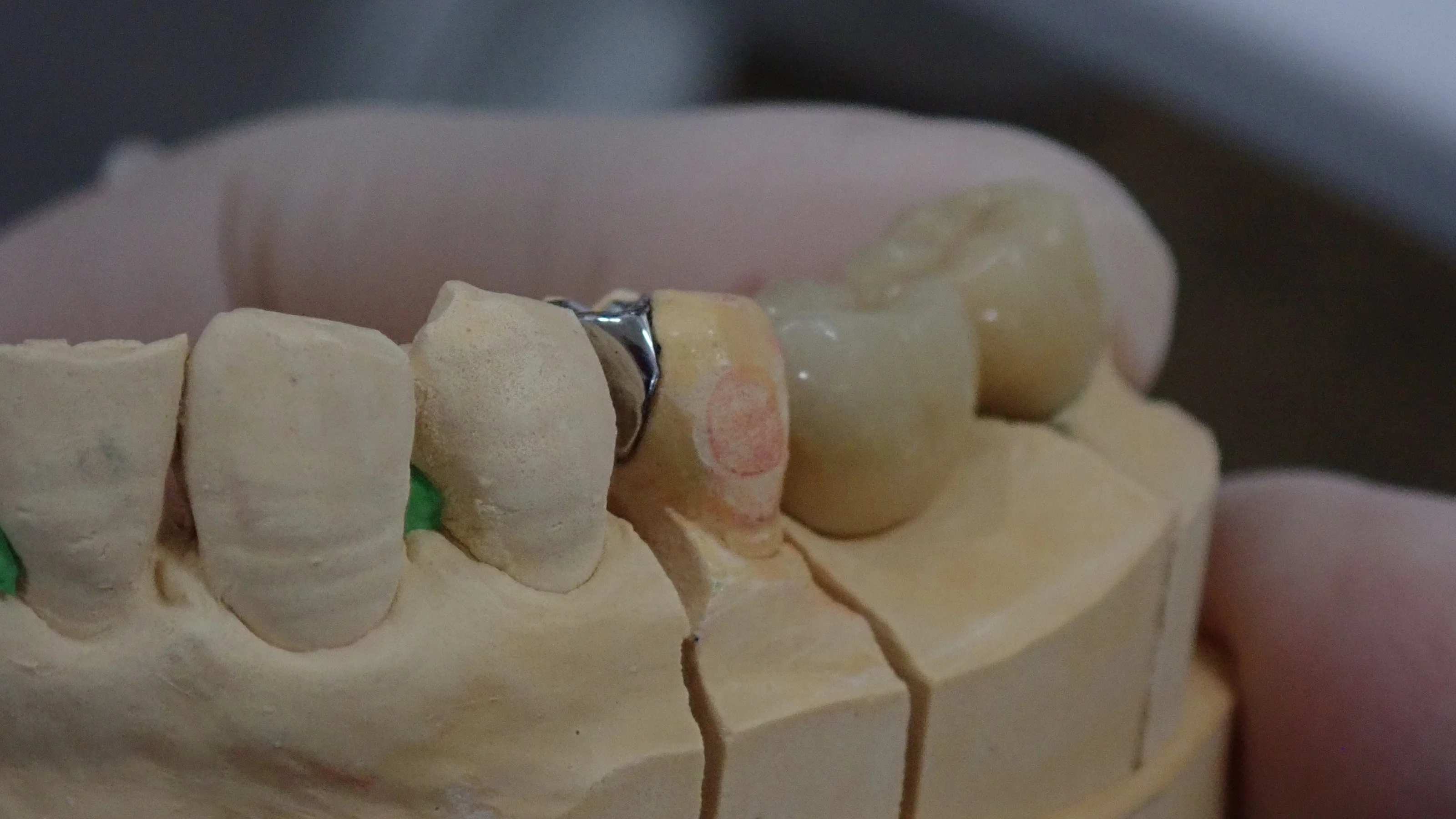 歯を可及的に温存したブリッジ｜坂寄歯科医院（取手市藤代） - 画像6