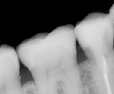 歯の亀裂で痛みが出たため、被せ物に。|坂寄歯科医院(取手市藤代) - 画像4
