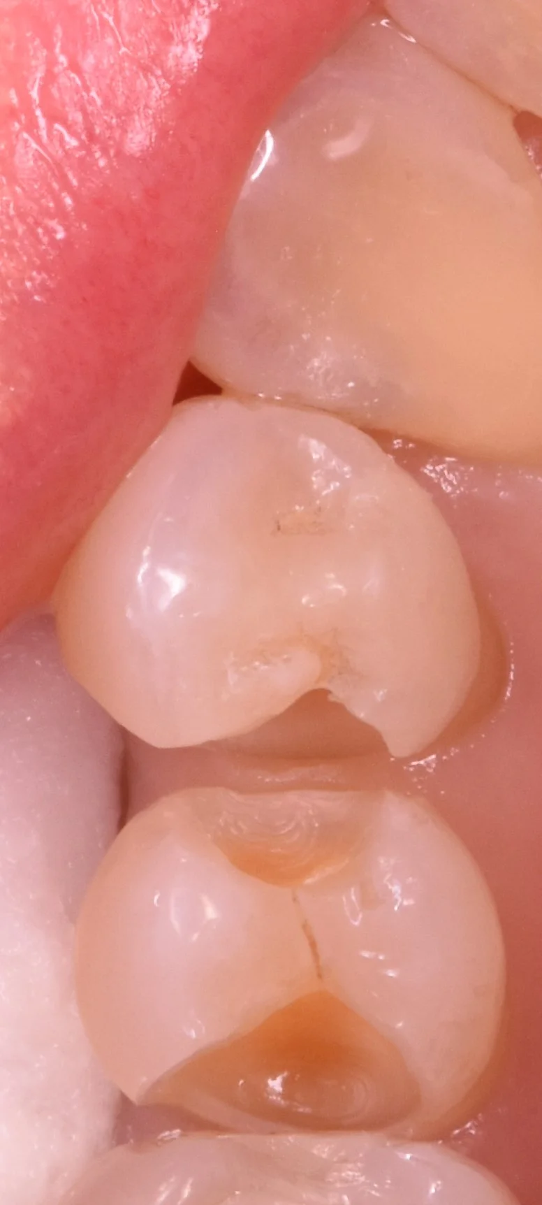 奥歯の歯並びが悪くなってしまっている所の治療|坂寄歯科医院(取手市藤代) - 画像3