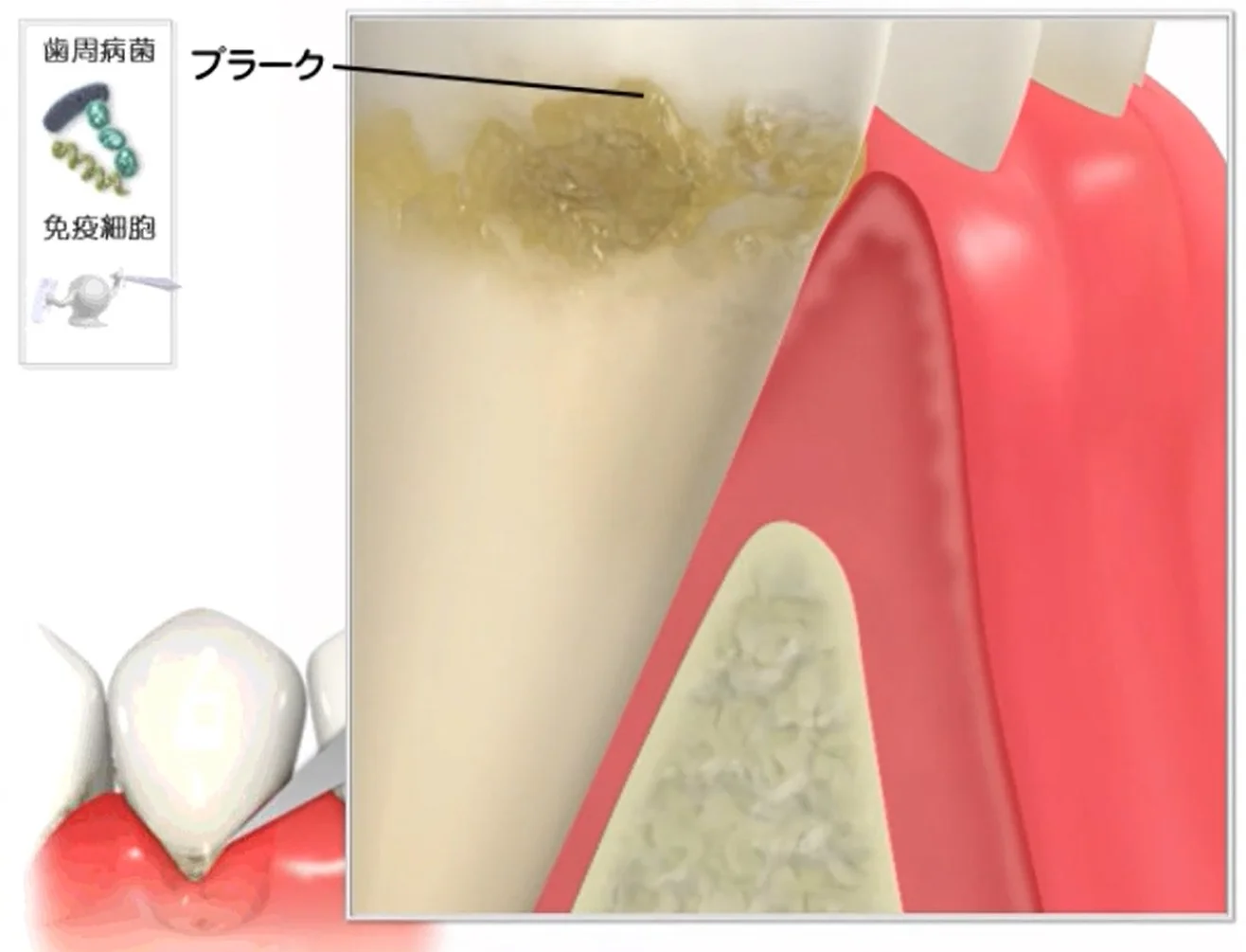 Q&A～歯周病ってなに？①～｜坂寄歯科医院（取手市藤代） - 画像2