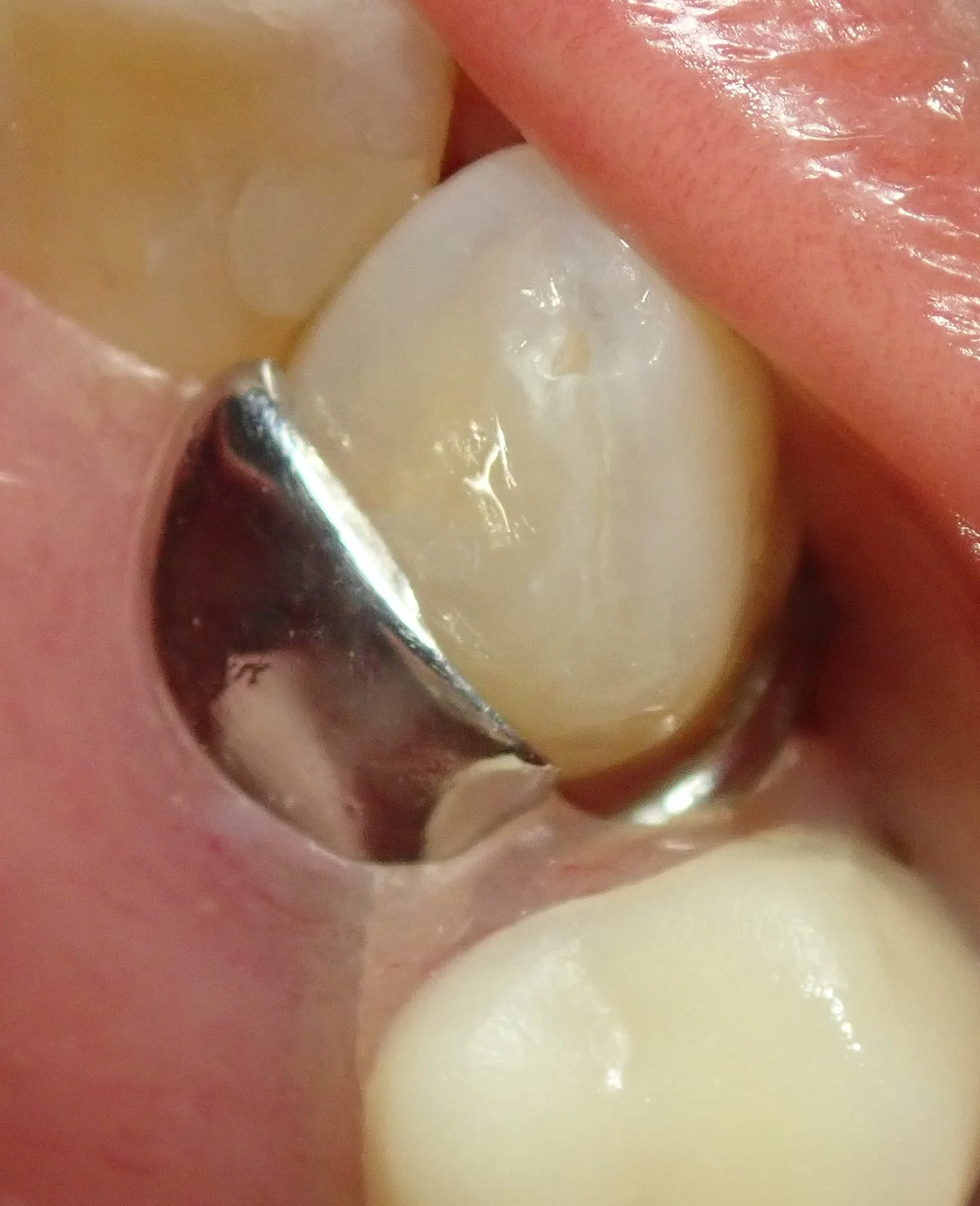 右上犬歯の白い詰め物|坂寄歯科医院(取手市藤代) - 画像7