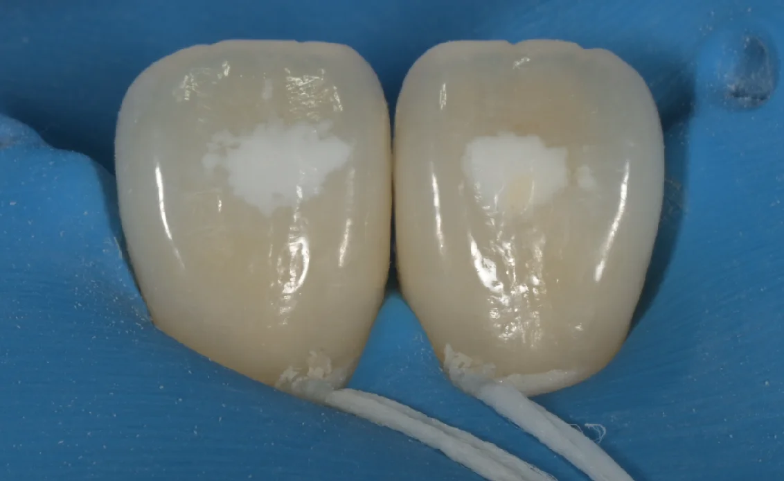 ICON治療。｜坂寄歯科医院（取手市藤代） - 画像3