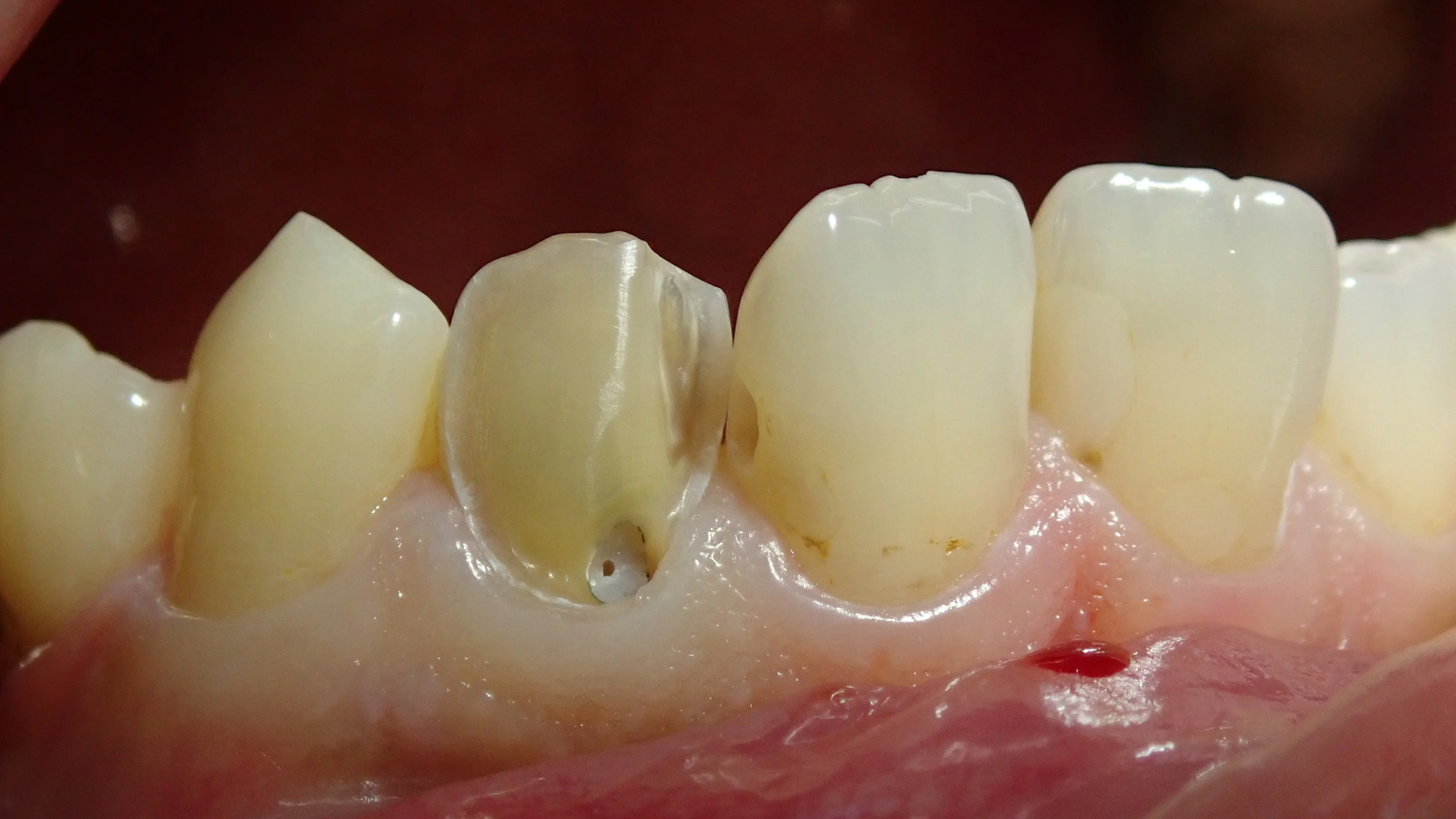 前歯のダイレクトベニア｜坂寄歯科医院（取手市藤代） - 画像3