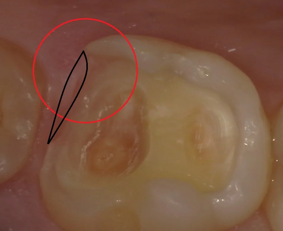 難易度の高い白い詰め物。｜坂寄歯科医院（取手市藤代） - 画像3