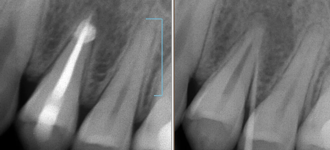中心結節破折が原因で起こった神経の壊死を放置して、外部吸収が起こったケース|坂寄歯科医院(取手市藤代) - 画像2