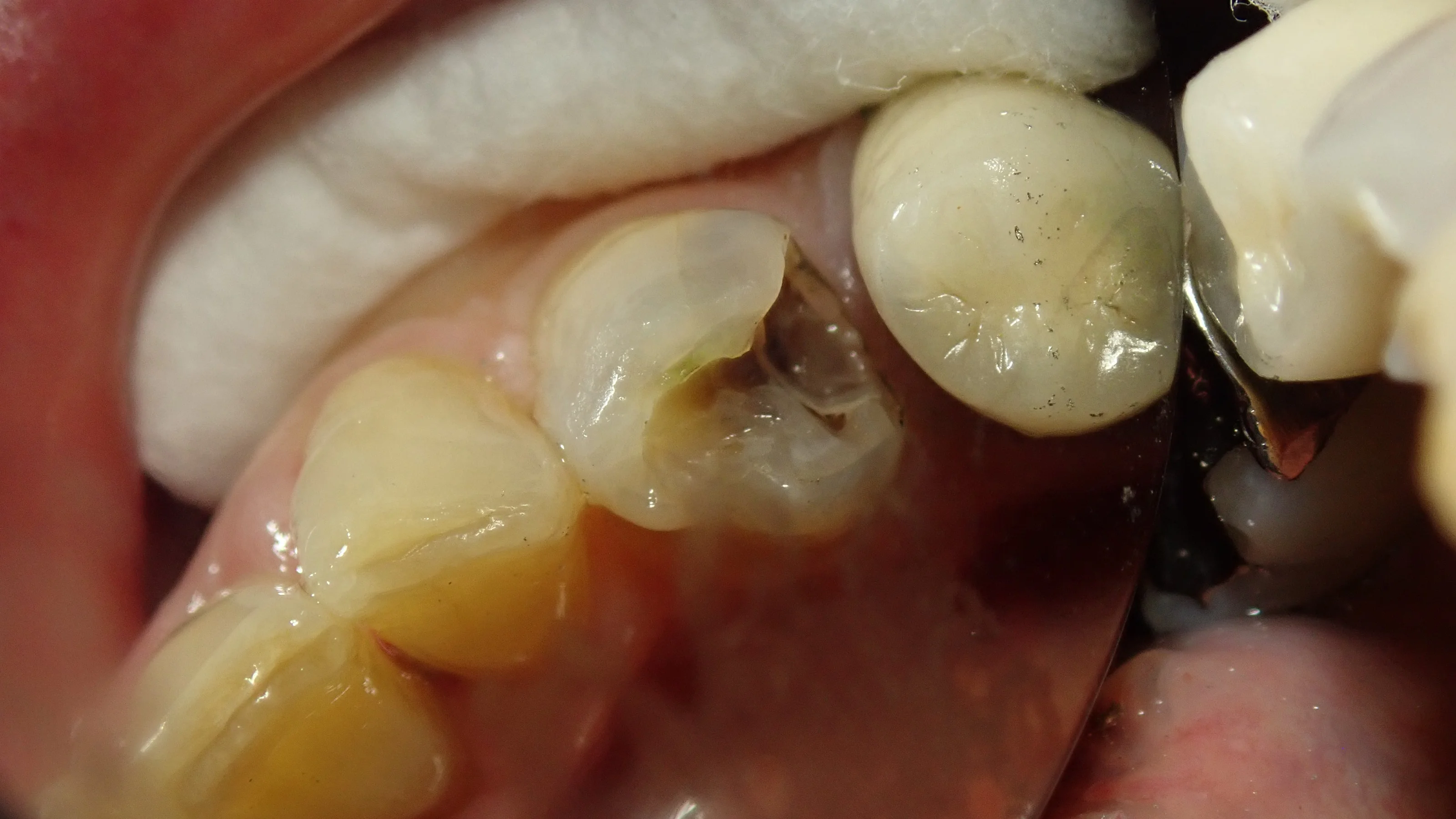 ダイレクトボンディング|坂寄歯科医院(取手市藤代) - 画像2