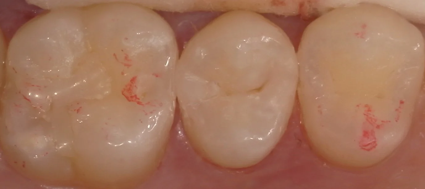 遠方から白い詰め物での治療を求めて・・・|坂寄歯科医院(取手市藤代) - 画像5