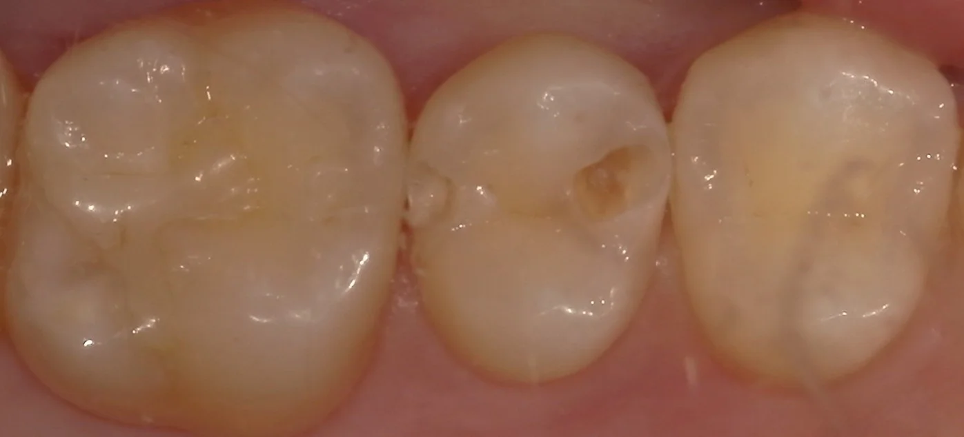 遠方から白い詰め物での治療を求めて・・・|坂寄歯科医院(取手市藤代) - 画像3