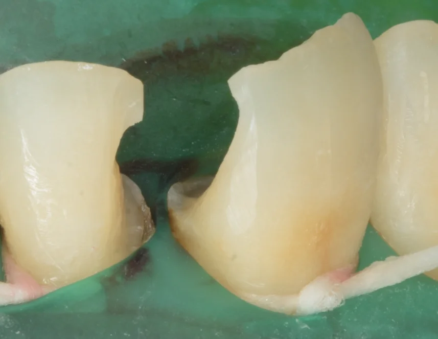 不適合なレジンを再治療。｜坂寄歯科医院（取手市藤代） - 画像2