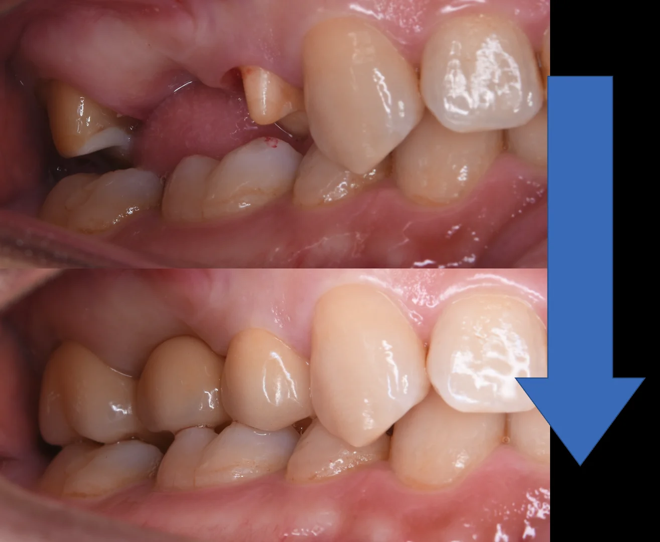 セラミックのブリッジ｜坂寄歯科医院（取手市藤代） - 画像3