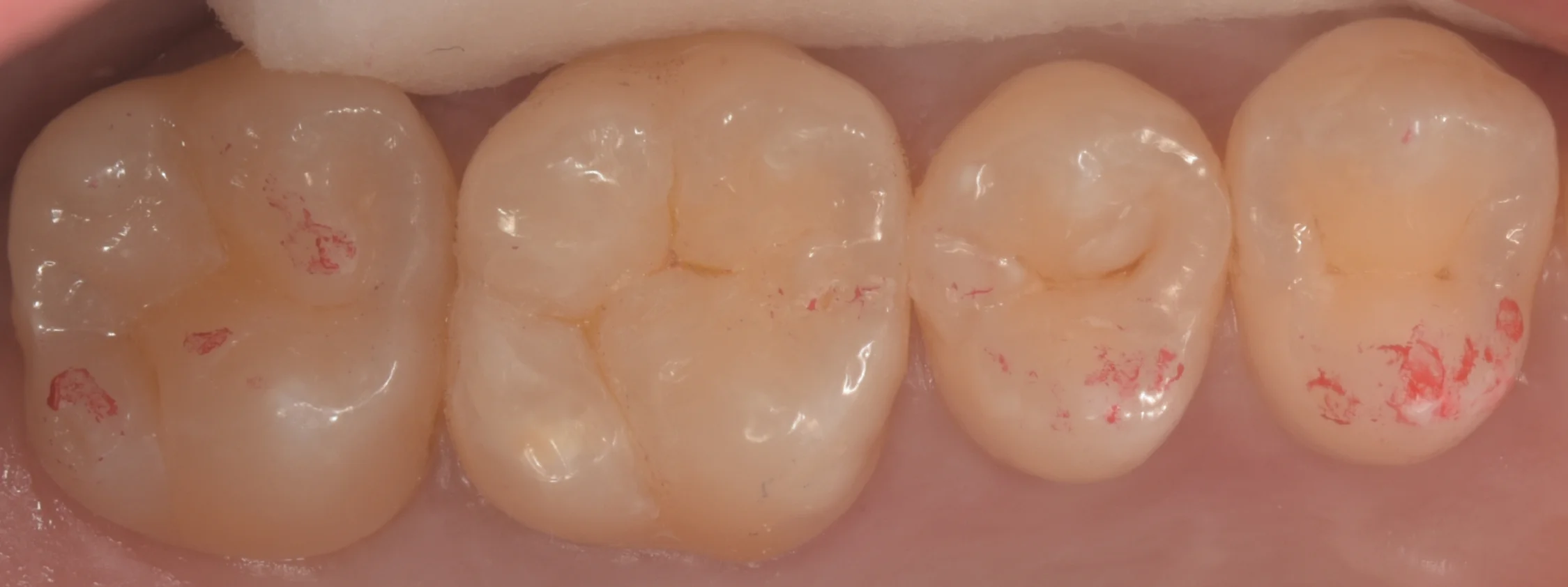 遠方より歯の治療を希望して｜坂寄歯科医院（取手市藤代） - 画像4