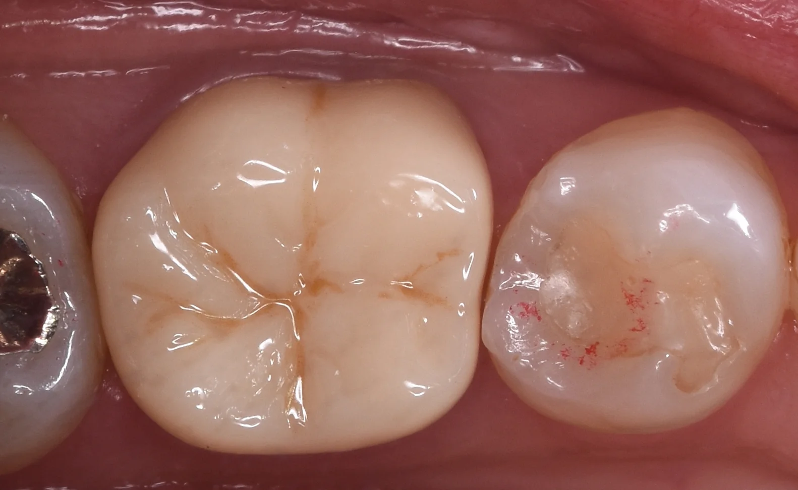セラミックの被せ物|坂寄歯科医院(取手市藤代) - 画像4